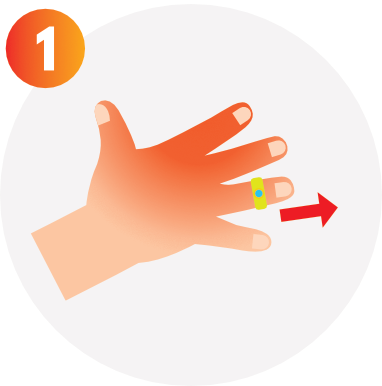 burns first aid step 1 remove jewellery